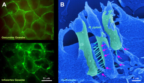 (A) Gesundes und mit Helicobacter pylori Bakterien infiziertes Epithelzellgewebe (grün), das im menschlichen Magen zerstört wurde. (B) Elektronenmikroskopie von drei vergrößerten Bakterien (hellgrün). Rote Pfeile markieren die hervorstechende „Giftspritze“, wodurch letztendlich Krebs induziert werden kann. (Bilder: A: FAU/Prof. Steffen Backert, Aileen Harrer; B: Prof. Manfred Rohde (HZI, Braunschweig))